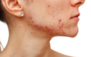 Portret lica mlade žene u profilu desno s aknama na koži