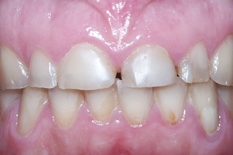 Zubi gornje i donje vilice oštećeni bruksizmom