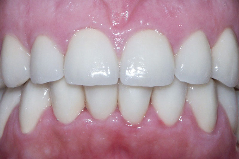 Zubi gornje i donje vilice pacijenta s bruksizmom nakon terapije