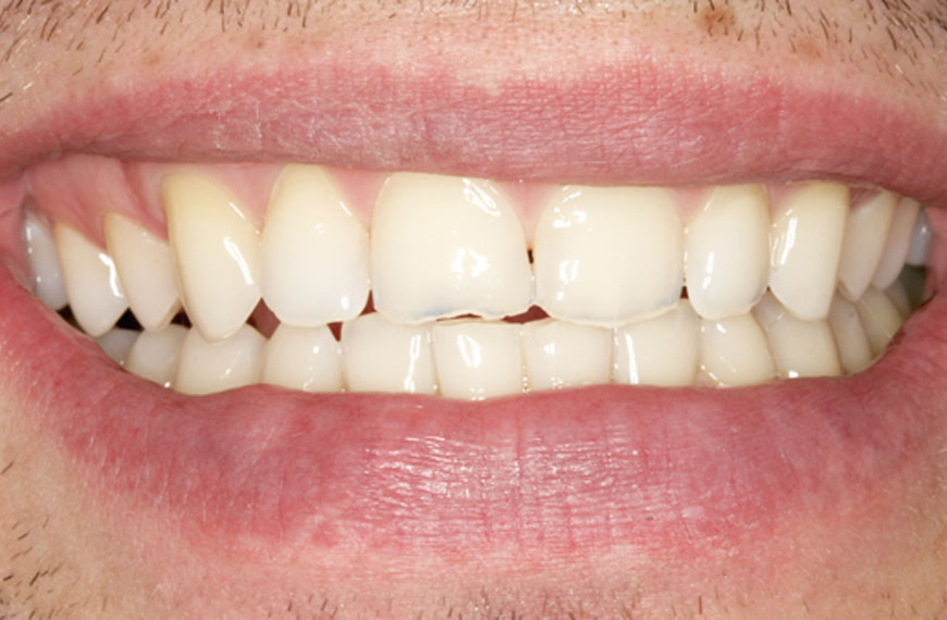 Osmijeh muškarca sa zubima oštećenim od bruksizma