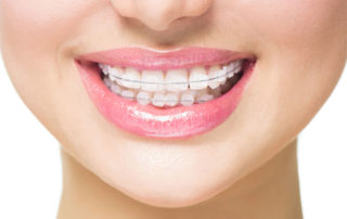 Ženski osmijeh s aparatićem za zube