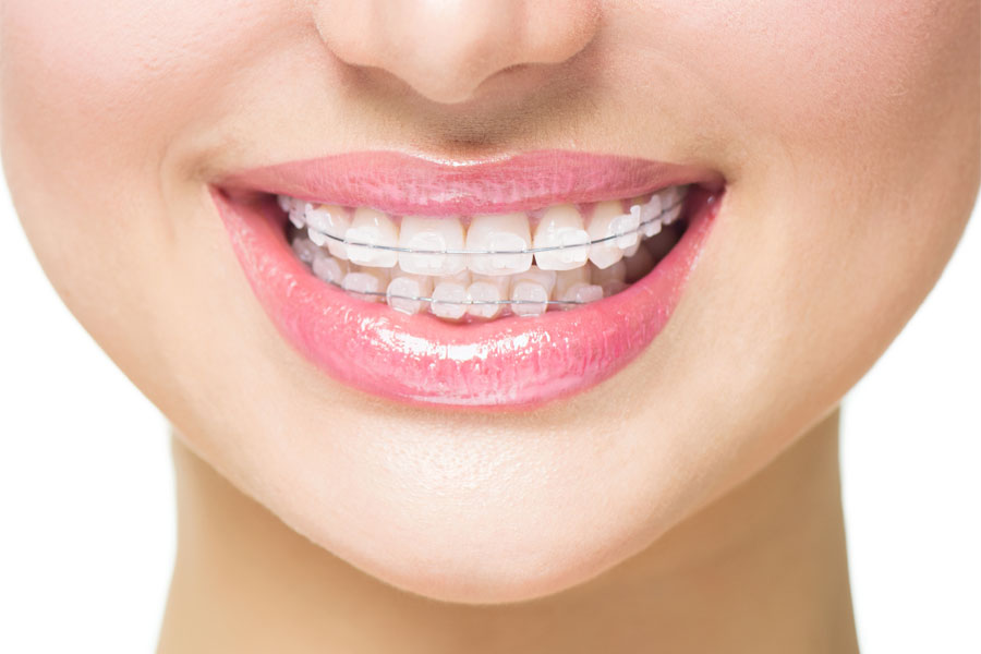 Ženski osmijeh s aparatićem za zube