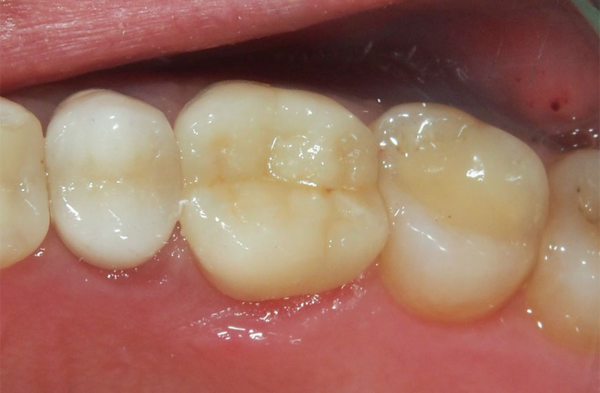 Slika 4 zuba s jednim koji ima estetski bijeli keramički ispun