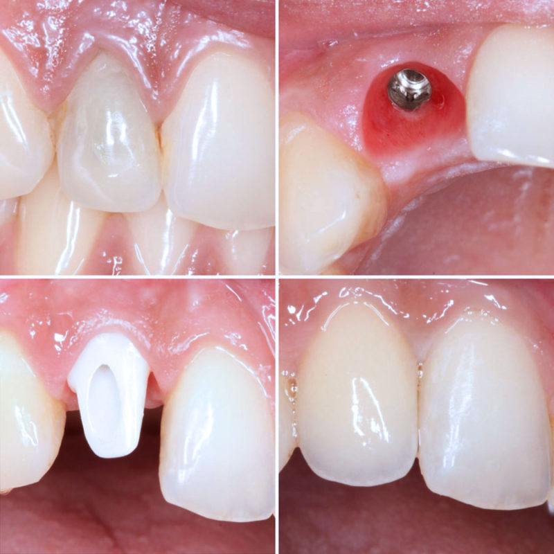 Kolaž zubi prije i poslije postavljanja jednog dentlanog implantata