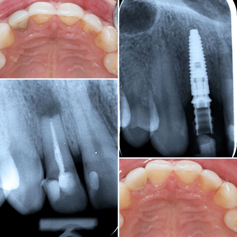 Kolaž zubi i ortopana prije i poslije postavljanja jednog dentlanog implantata