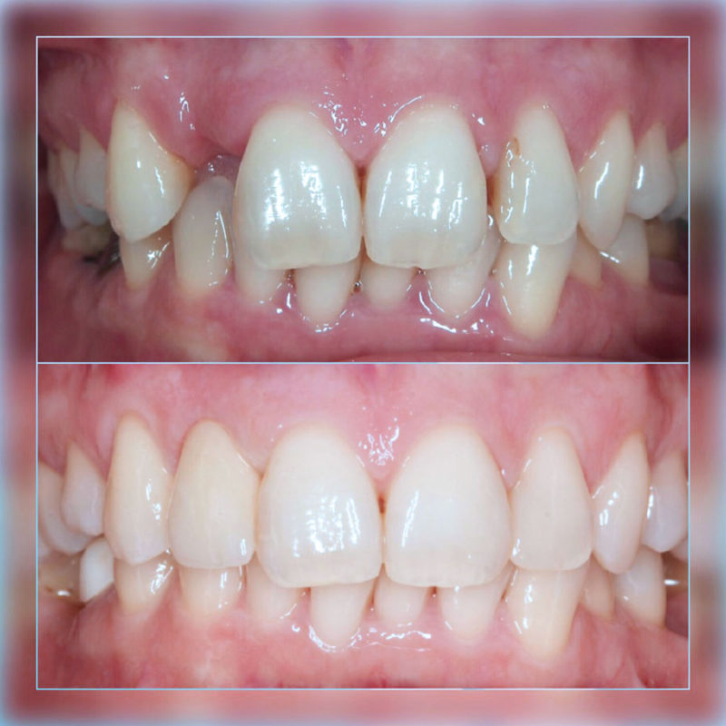 Slika gornje i donje vilice prije i poslije postavljanja dentalnog implantata