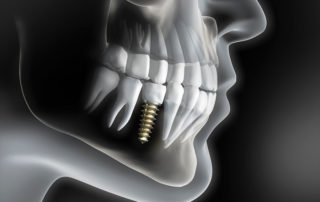 3D kompjuterska slika presjeka lica s implantatom u donjoj čeljusti