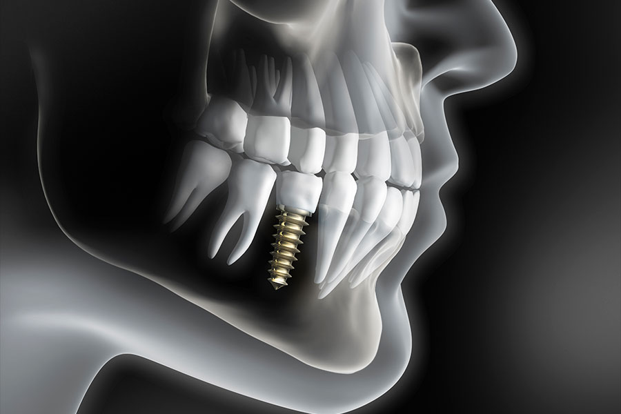 3D kompjuterska slika presjeka lica s implantatom u donjoj čeljusti