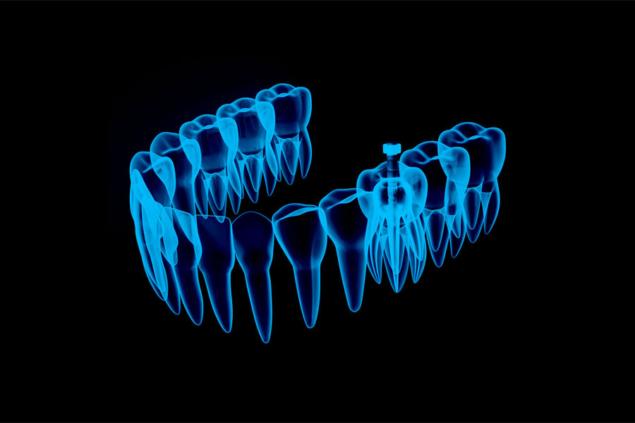 Crna pozadina s plavim 3D shematskim prikazom zubnog luka donje čeljusti s endodontskom iglicom u jednom zubu