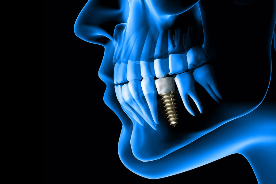 3D računalni prikaz lica, profil ulijevo, s zubima obje čeljusti i jednim implantatom u donjoj čeljusti