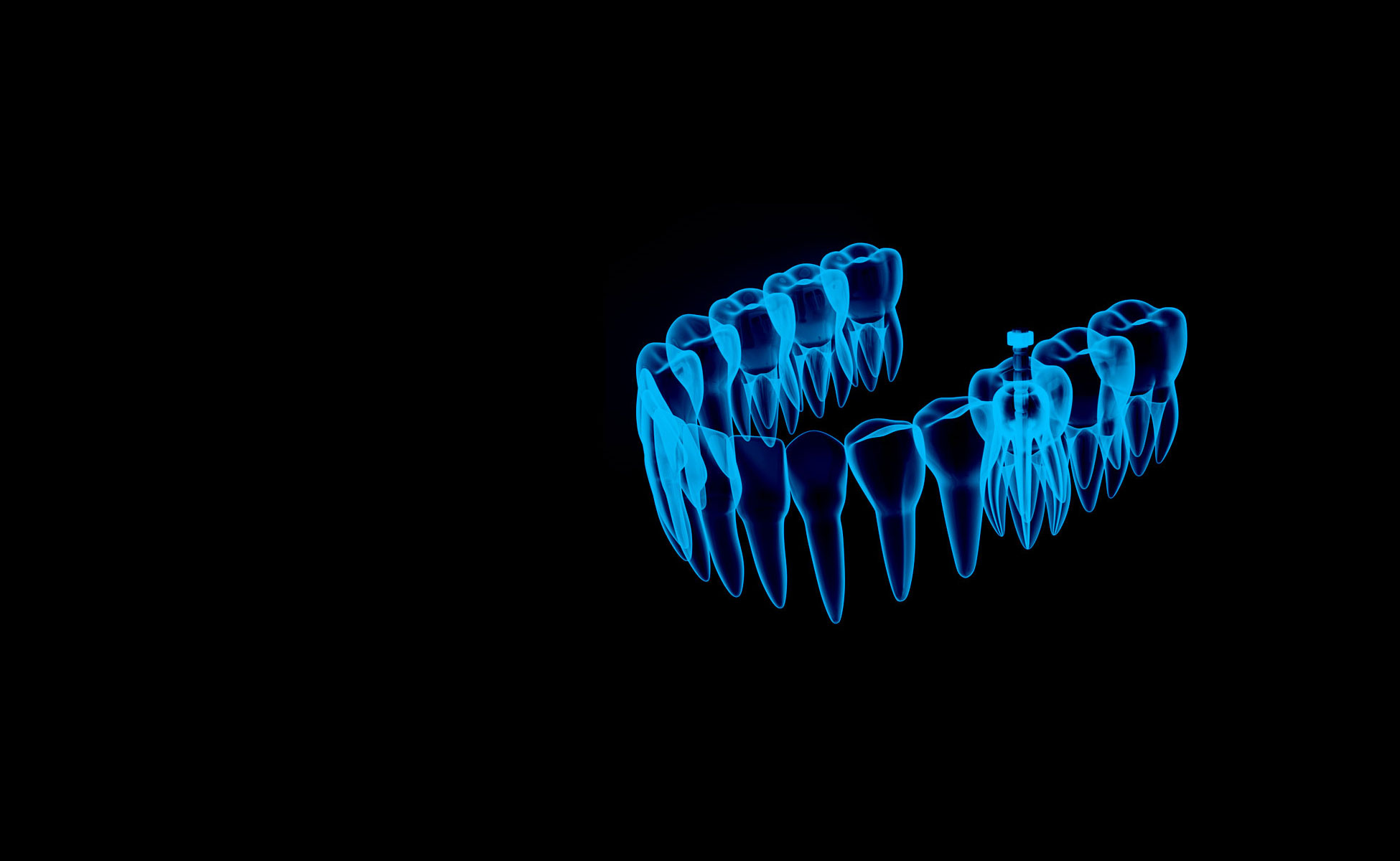Neonski plavi 3D shematski prikaz zubnog luka donje vilice s endodontskom iglicom u jednom od zuba