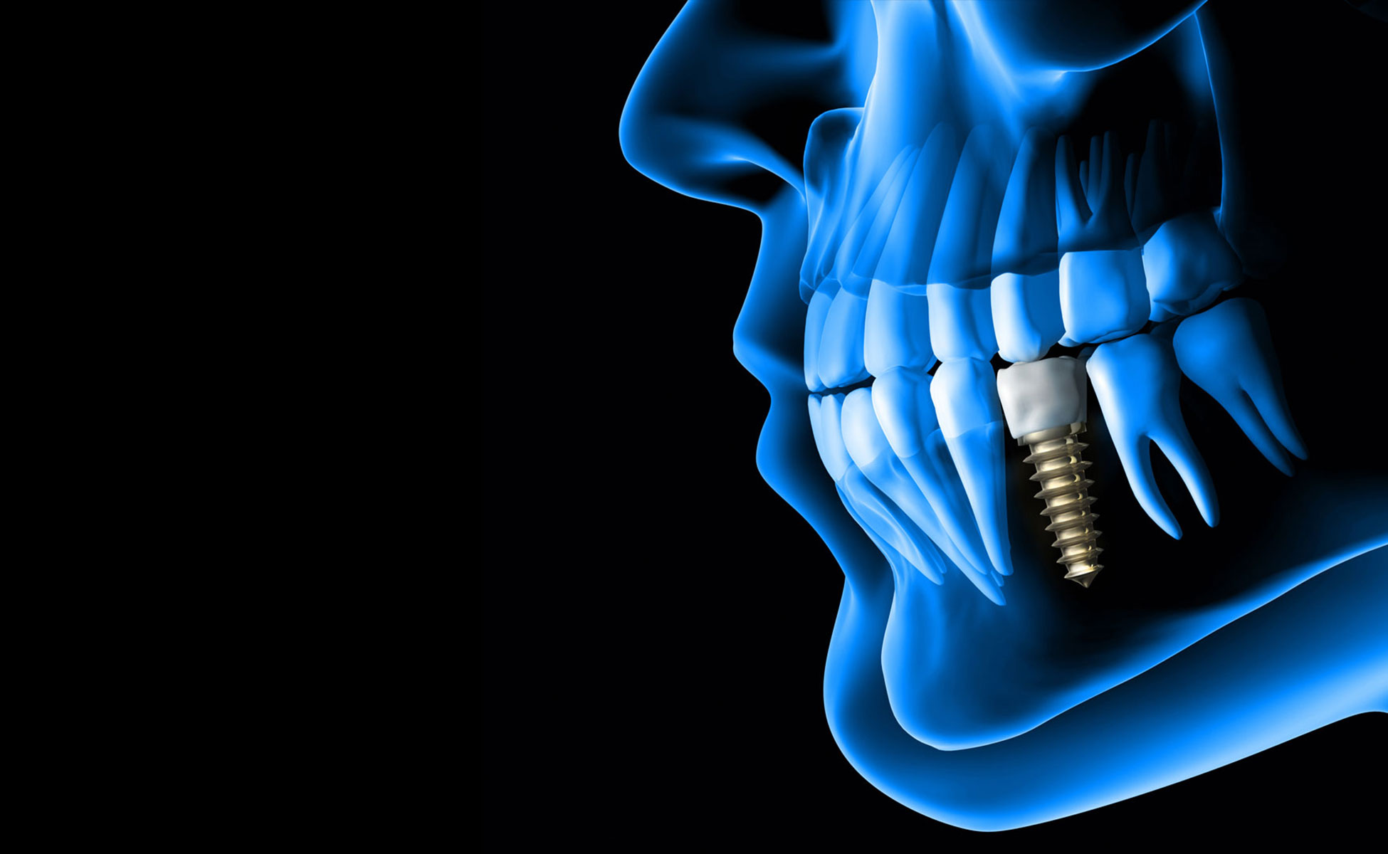 Plavi 3D prikaz lijevog profila gornje i donje čeljusti s implantatom u donoj čeljusti