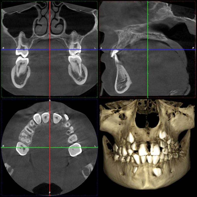 3D snimka čeljusti iz nekoliko kuteva, CBCT