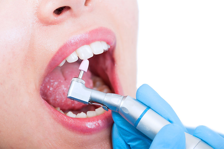 Pjeskarenje ženskih zubi posebnim stomatološkim uređajem
