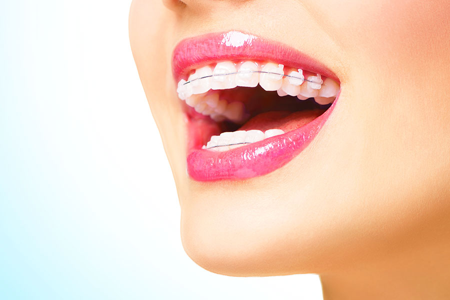Ženski osmijeh s ortodontskim aparatićem na gornjim i donjim zubima