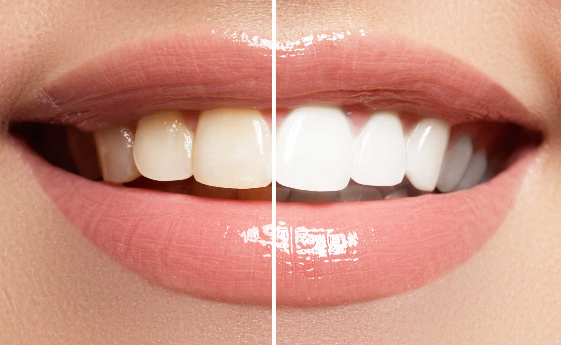 Ženski osmijeh podijeljen okomito, prije i poslije izbjeljivanja zubi