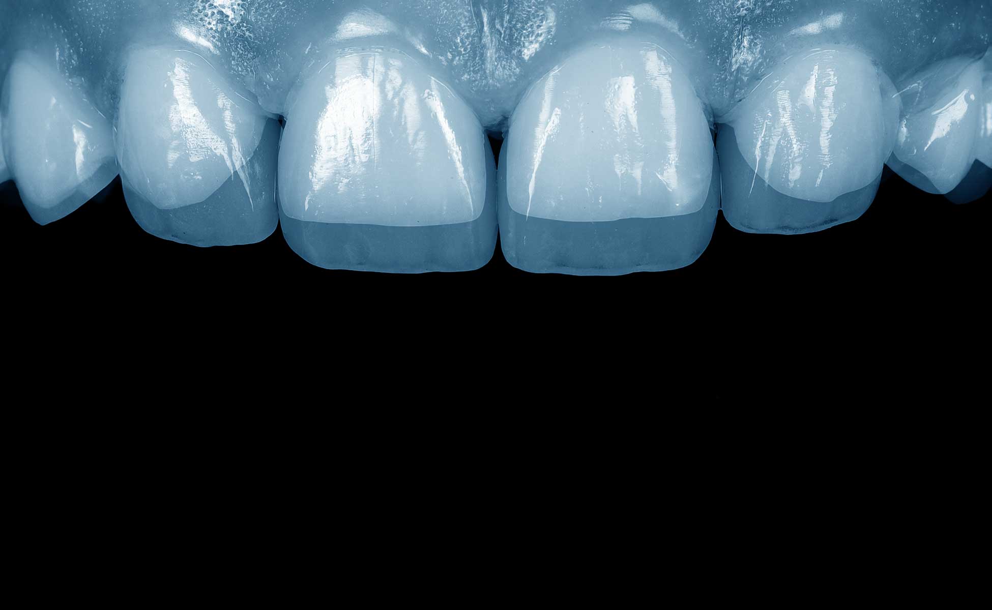 Prikaz prednjih zuba gornje vilice na tamnoj pozadini s prozirnim obrisom ljuskica za zube preko njih