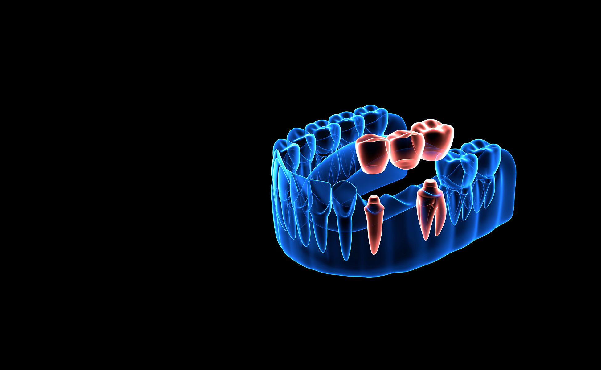3D prikaz donjeg zubala s odvojenim zubnim mostom od tri člana
