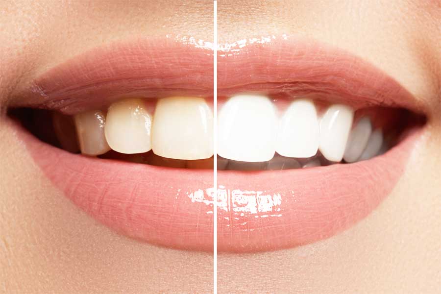 Ženski osmijeh, lijevo tamni zubi prije i desno svijetli zubi poslije izbjeljivanja