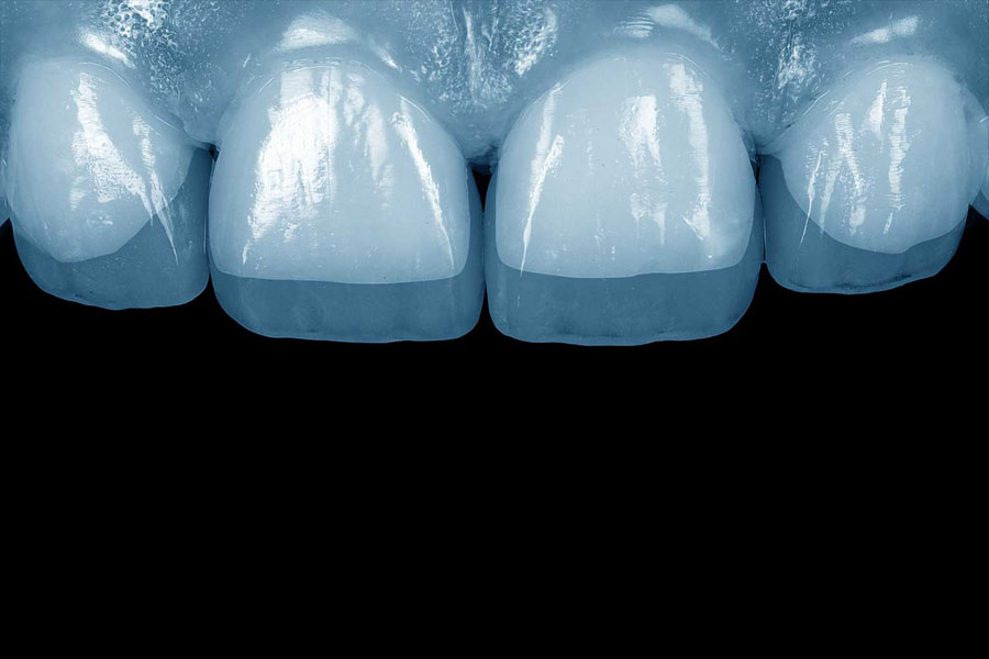 Shematski prikaz zuba gornje vilice sa superponiranim prozirnim zubnim ljuskicama