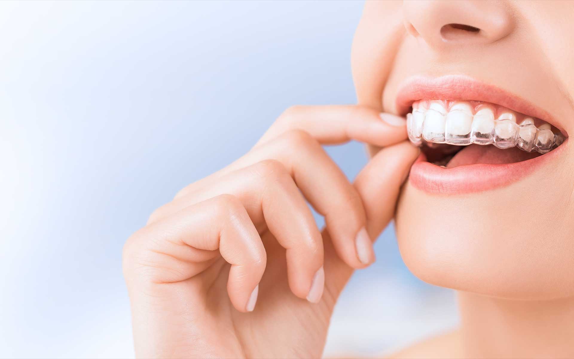 Ženska usta u koja se stavlja Invisalign prozirni aparatić za zube